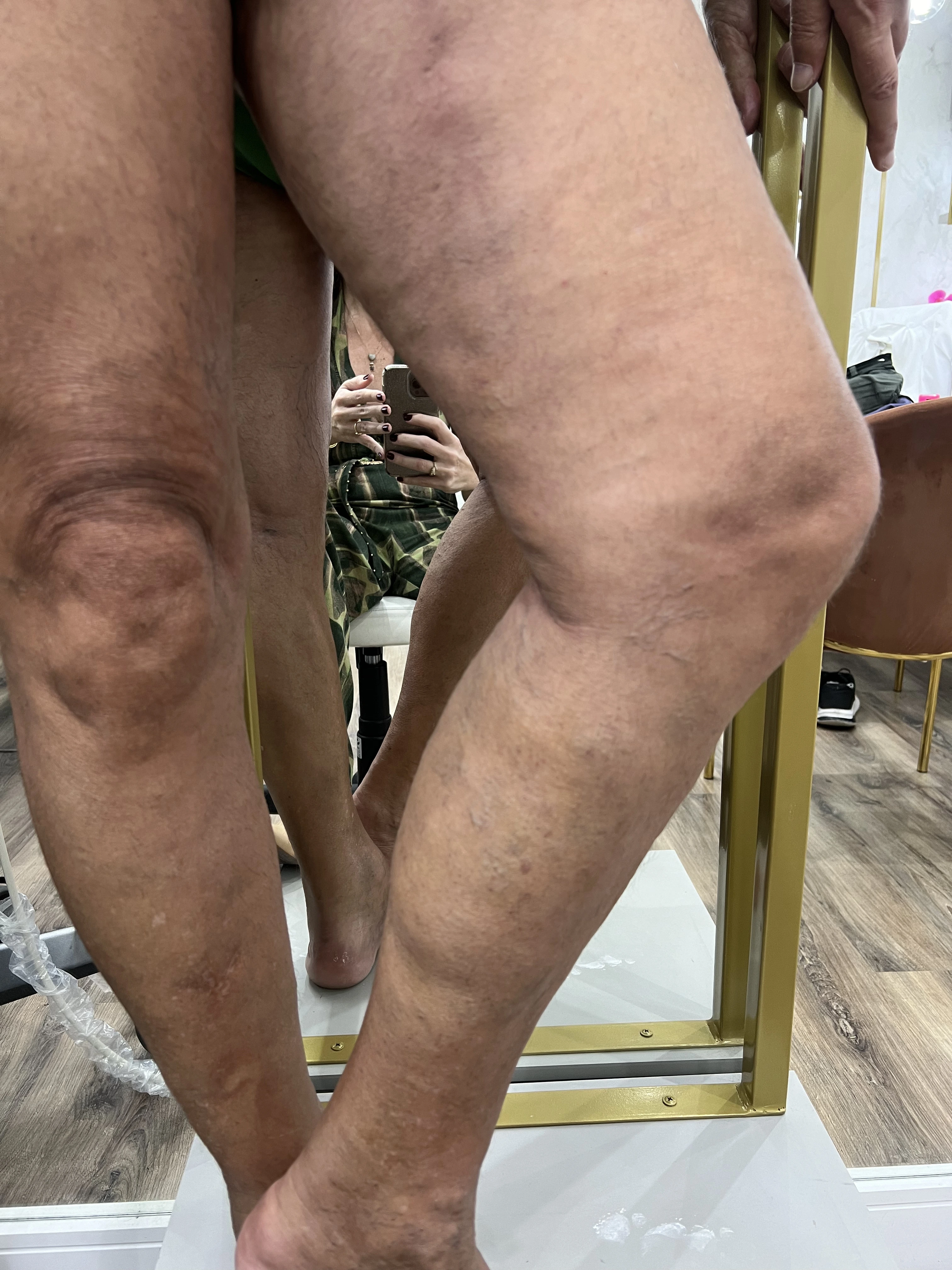 Pernas depois do tratamento Endolaser